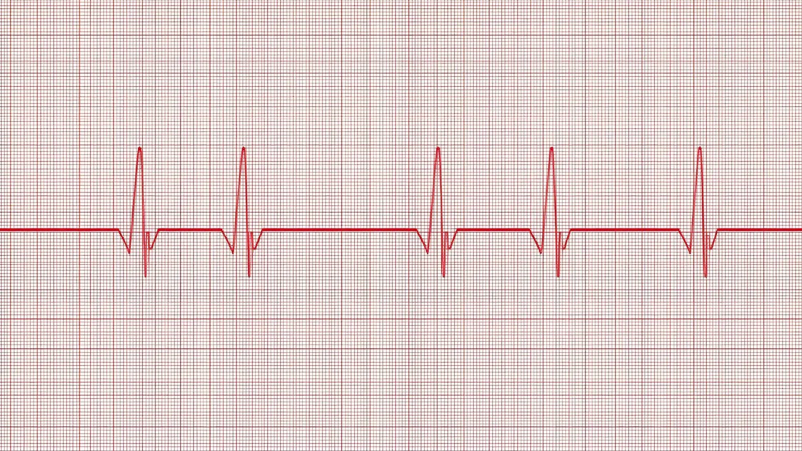 Read more about the article What Does Borderline ECG Mean+Example (2026) ❤️‍🩹
